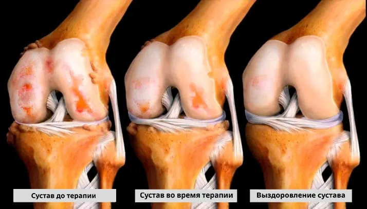Нанесение крема Arteron на кожу в области сустава